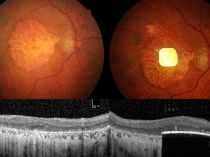 Prótesis Ocular revierte la ceguera