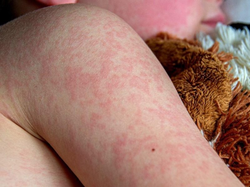sarampión, la varicela y el dengue