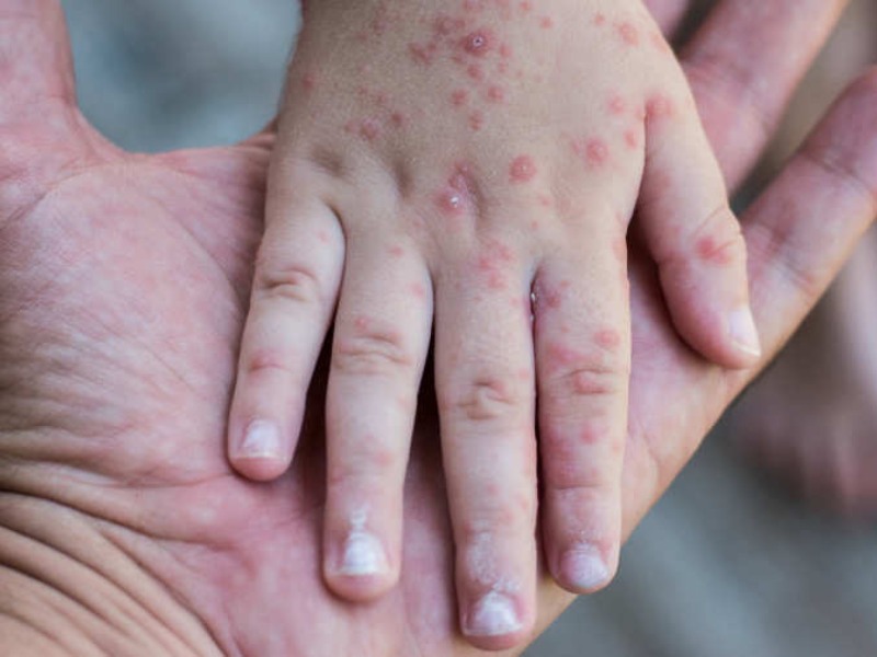 El Ministerio de Salud mantiene una campaña de vacunación para prevenir el sarampión. Foto EDH/Archivo